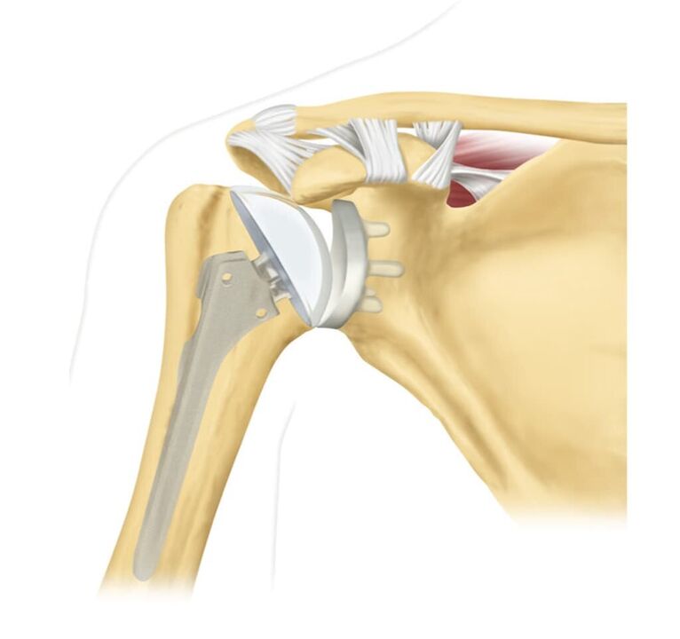 Replace a damaged shoulder joint with an organ