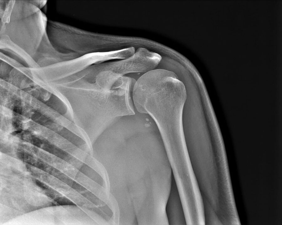 X-ray of shoulder joint 2 degree of severity. 