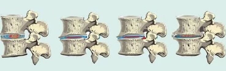 spinal cord injury in case of thoracic osteonecrosis
