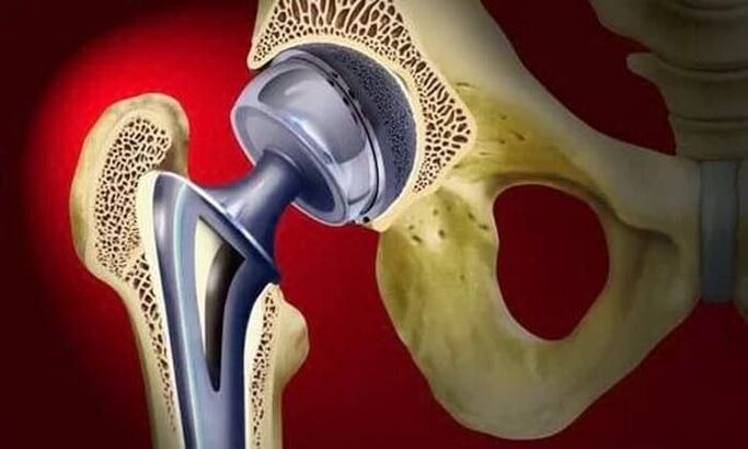 hip replacement for joint disease