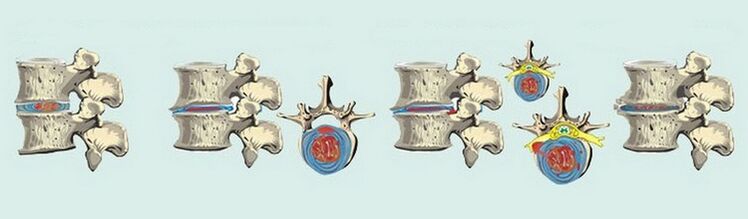 Stages of the formation of osteonecrosis of the spine