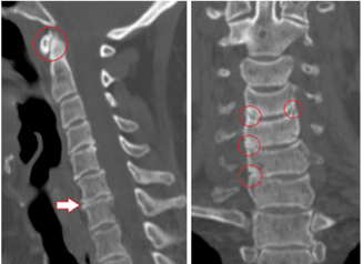 CT scan shows damaged vertebrae and discs of heterogeneous height due to thoracic osteonecrosis