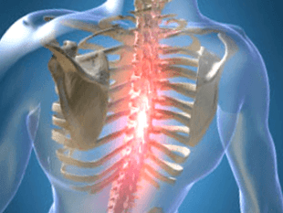 Recurrent or persistent pain in thoracic osteonecrosis