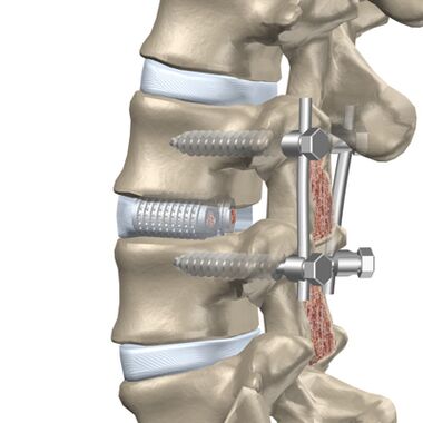 Replacing destroyed thoracic spinal discs with artificial implants