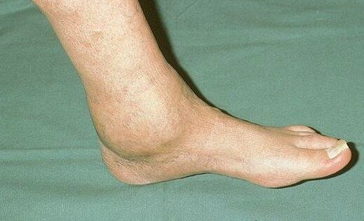 swollen ankle with arthritis