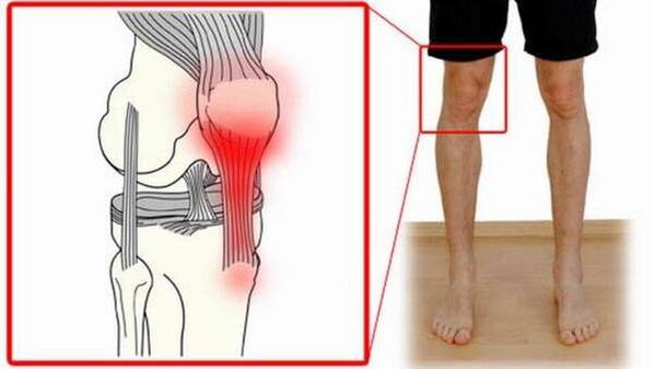 Joint damage in shoulder arthritis