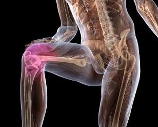 Arthritis of the knee with dry joints