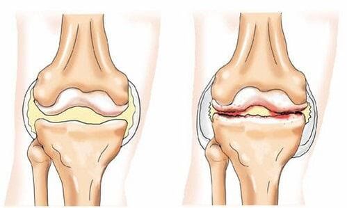 healthy knee joints and those affected by arthritis