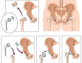 Arthroscopy for hip arthritis
