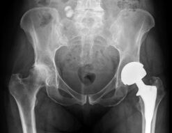Diagnosis of hip osteoarthritis