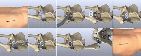 Treatment methods for hip osteoarthritis