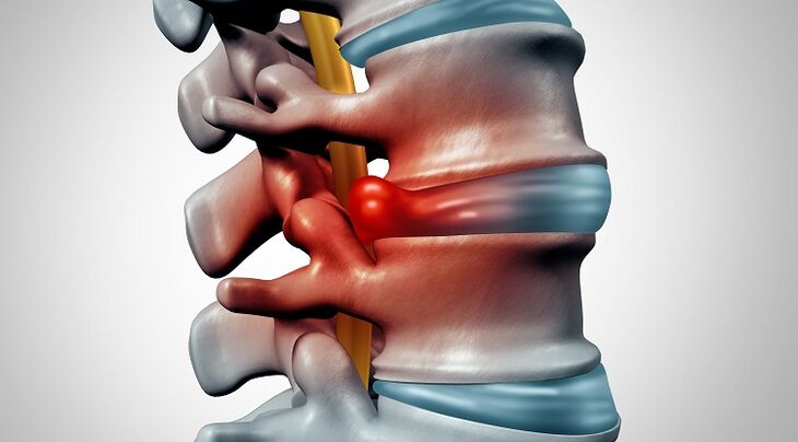 disc herniation with osteonecrosis